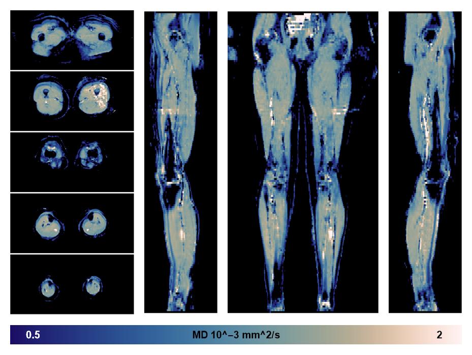 IVIM corrected whole leg muscle mean diffusivity obtained from diffusion tensor imaging.